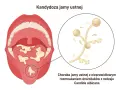 Ilustracja jamy ustnej z nalotem na języku i powiększony obraz grzybów Candida albicans.