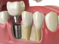 Przekrój szczęki pokazujący implant zębowy i koronę. Dowiedz się, ile kosztuje wstawienie zęba 4.