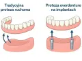 Porównanie tradycyjnej protezy ruchomej z protezą overdenture na implantach. Proteza na NFZ może być dostępna w obu wariantach.