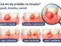 Guzek na dziąśle, krostka, ropa, przetoka, a nawet nadżerka – to objawy, które mogą wskazywać na nadziąślaka. Ilustracje pokazują różne stadia problemu.