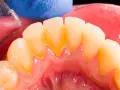 Widok zębów z widocznym kamieniem nazębnym. Dentysta pokazuje, jak pozbyć się kamienia z zębów, używając narzędzi.