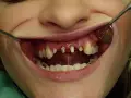 Uśmiech z widocznymi ubytkami i zębami wymagającymi leczenia. Rozważasz **korona porcelanowa cena**?