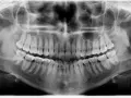 Pantomogram zębów, ukazujący uzębienie i kości szczęki. Sprawdź pantomogram cena, aby dowiedzieć się więcej o kosztach badania.