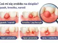 Ilustracja przedstawia różne zmiany na dziąśle: guzek, krostkę, ropę i ranę.