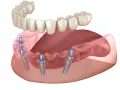 Proteza na 2 implantach cena. Górna szczęka i dolna proteza z implantami.