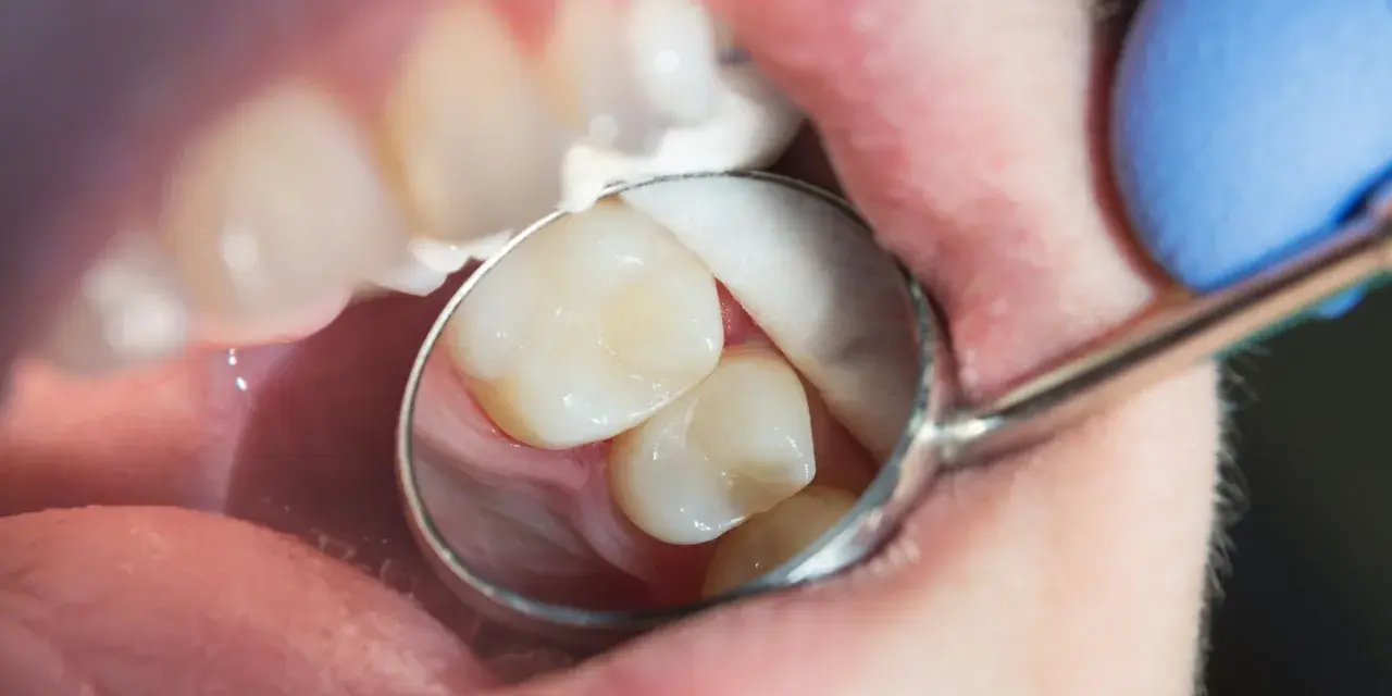 Zbliżenie na zęby w jamie ustnej, oglądane przez lusterko dentystyczne.