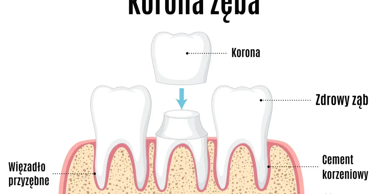 Odbudowa zęba jedynki cena. Ilustracja pokazuje koronę zęba, przygotowanie do jej założenia i zdrowe zęby.
