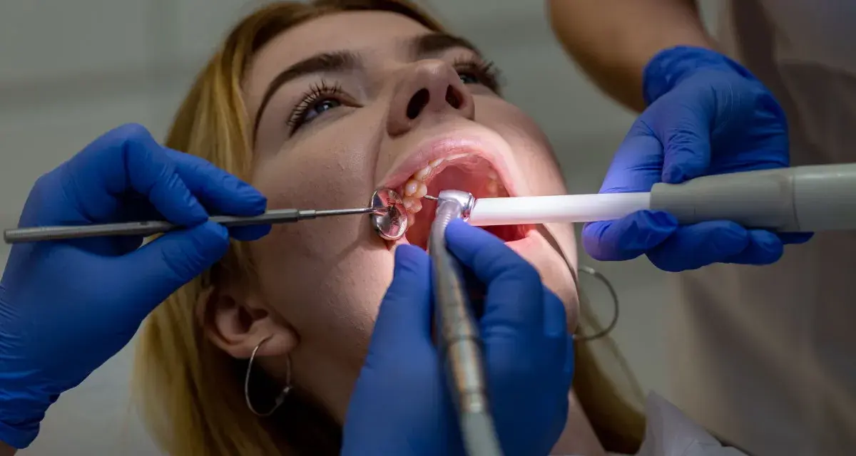 Dentysta zakłada tymczasowe wypełnienie zęba, używając wiertła i lusterka.