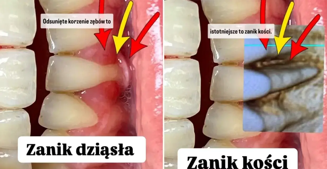 Czy dziąsła odrastają? Prawda o recesji i odbudowie dziąseł