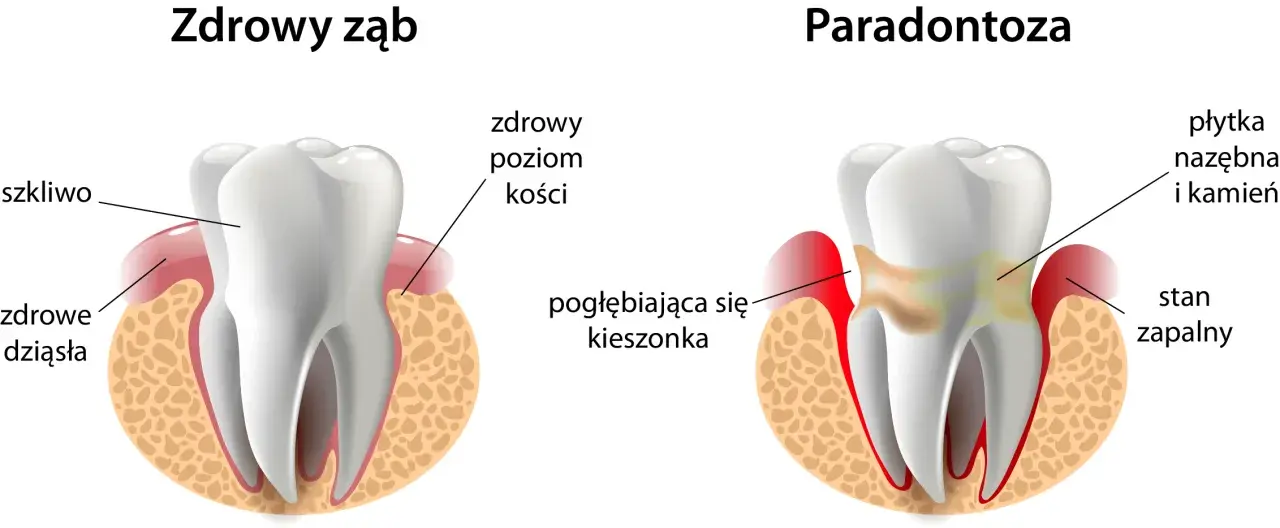 Zdrowe dziąsła: Jak dbać, by uniknąć paradontozy i krwawienia?