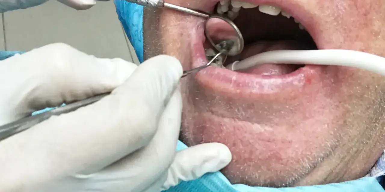 Dentysta w białych rękawiczkach bada usta pacjenta za pomocą lusterka i narzędzi stomatologicznych.