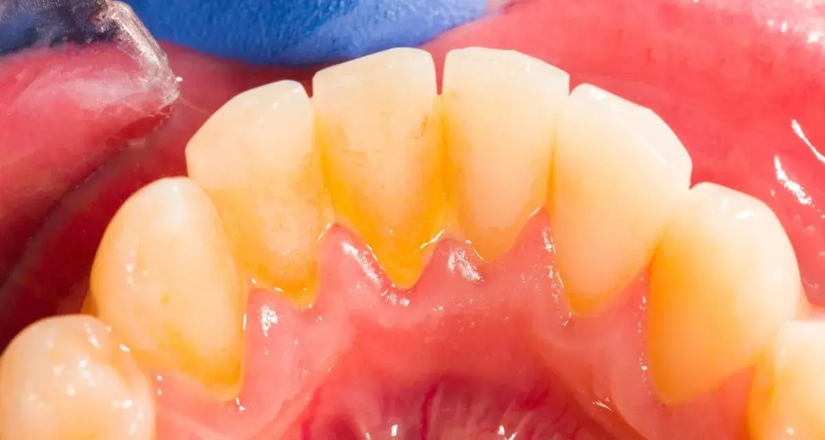 Widok zębów z widocznym kamieniem nazębnym. Dentysta pokazuje, jak pozbyć się kamienia z zębów, używając narzędzi.