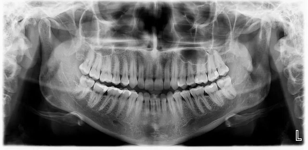 Pantomogram zębów, ukazujący uzębienie i kości szczęki. Sprawdź pantomogram cena, aby dowiedzieć się więcej o kosztach badania.
