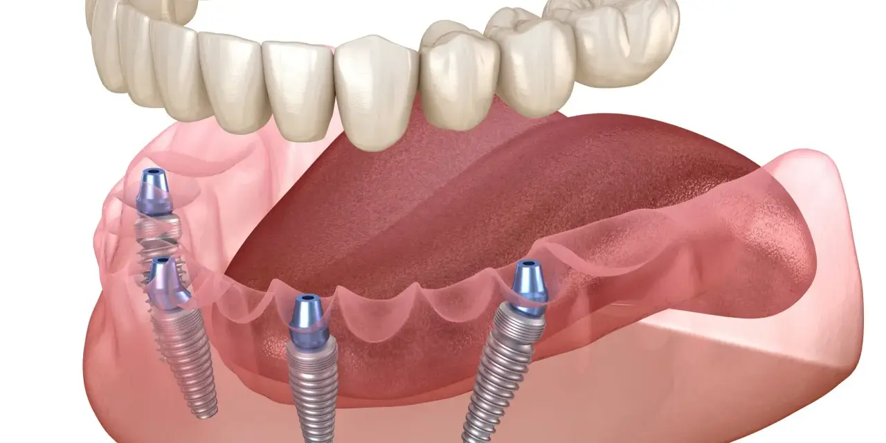 Proteza na 2 implantach cena. Górna szczęka i dolna proteza z implantami.