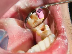 Ząb po leczeniu kanałowym boli przy nacisku. Widoczny fragment jamy ustnej z lusterkiem dentystycznym pokazującym ząb z narzędziem endodontycznym.