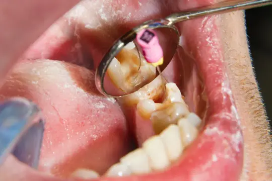 Ząb po leczeniu kanałowym boli przy nacisku. Widoczny fragment jamy ustnej z lusterkiem dentystycznym pokazującym ząb z narzędziem endodontycznym.
