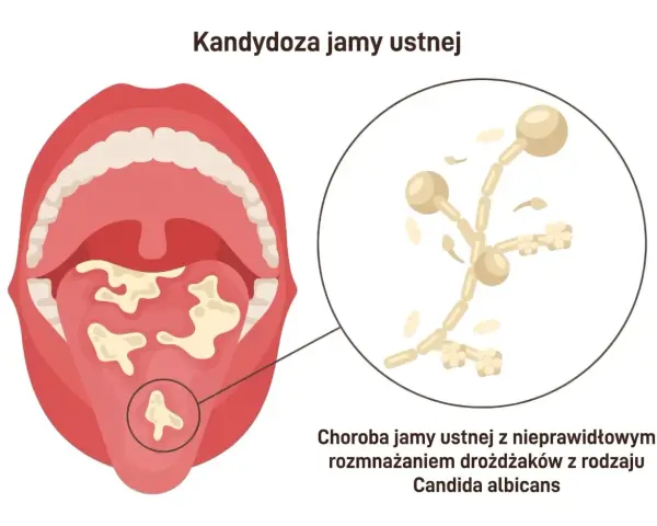 Ilustracja jamy ustnej z nalotem na języku i powiększony obraz grzybów Candida albicans.