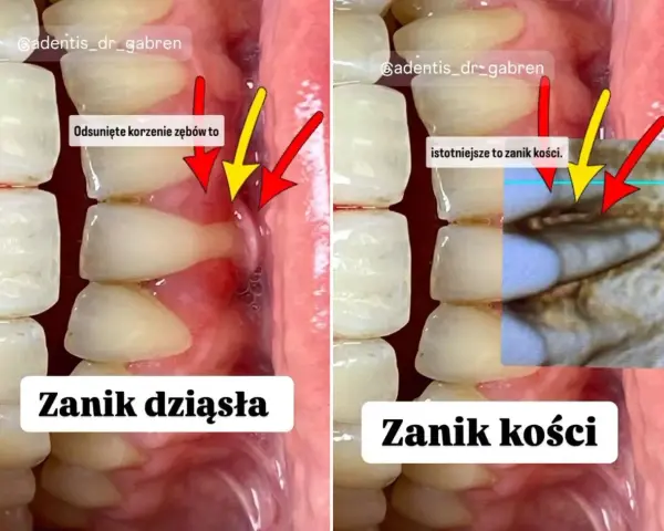 Czy dziąsła odrastają? Prawda o recesji i odbudowie dziąseł