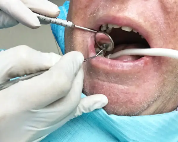 Dentysta w białych rękawiczkach bada usta pacjenta za pomocą lusterka i narzędzi stomatologicznych.
