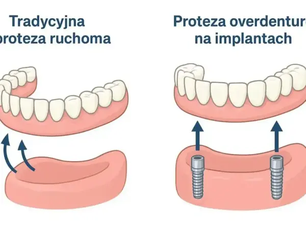 Porównanie tradycyjnej protezy ruchomej z protezą overdenture na implantach. Proteza na NFZ może być dostępna w obu wariantach.