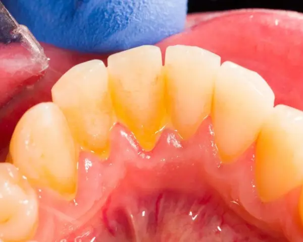Widok zębów z widocznym kamieniem nazębnym. Dentysta pokazuje, jak pozbyć się kamienia z zębów, używając narzędzi.