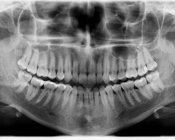 Pantomogram zębów, ukazujący uzębienie i kości szczęki. Sprawdź pantomogram cena, aby dowiedzieć się więcej o kosztach badania.