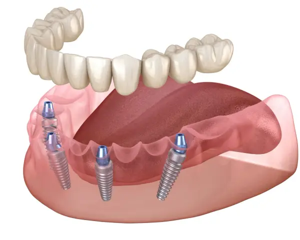 Proteza na 2 implantach cena. Górna szczęka i dolna proteza z implantami.