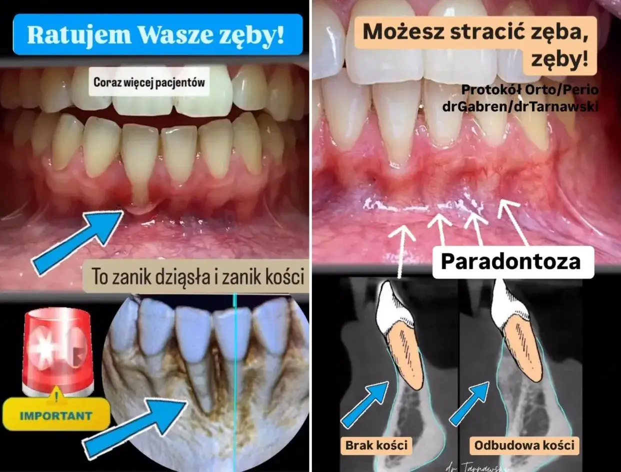 zdrowe dziąsła a recesja