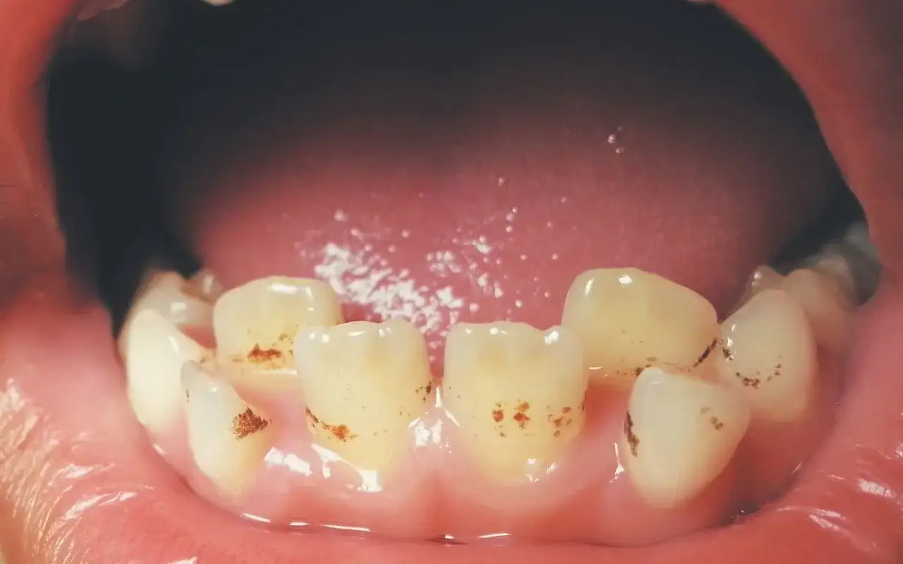 Widoczne brązowe kreski na zębach, świadczące o potrzebie wizyty u dentysty.