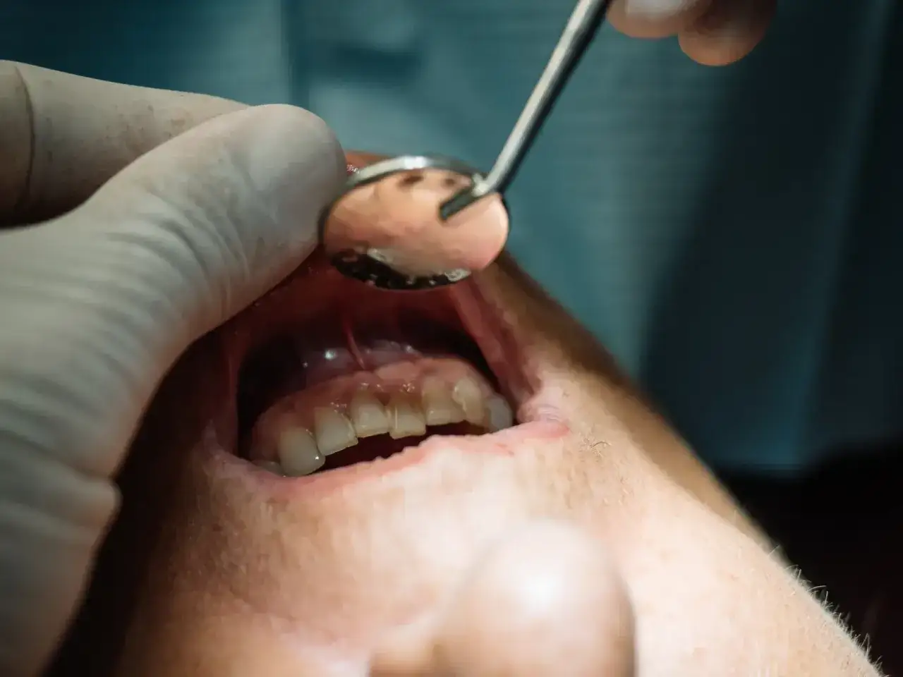 dentysta leczenie ropnia dziąsła