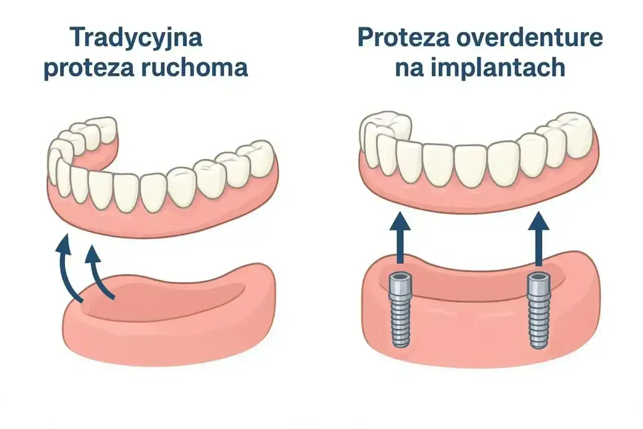 Porównanie tradycyjnej protezy ruchomej z protezą overdenture na implantach. Proteza na NFZ może być dostępna w obu wariantach.