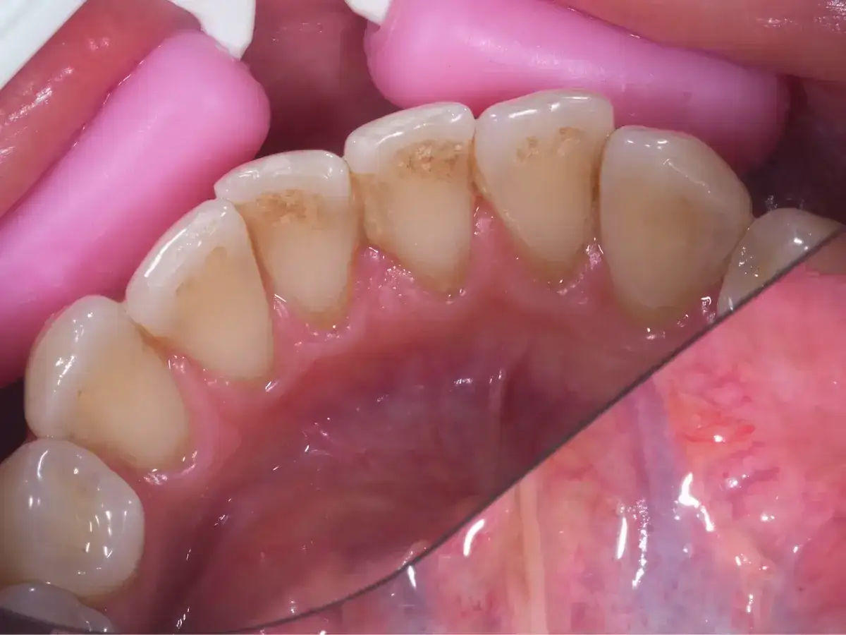 Widoczne przebarwienia i czarny osad na zębach, widoczne są też różowe retraktory dentystyczne.