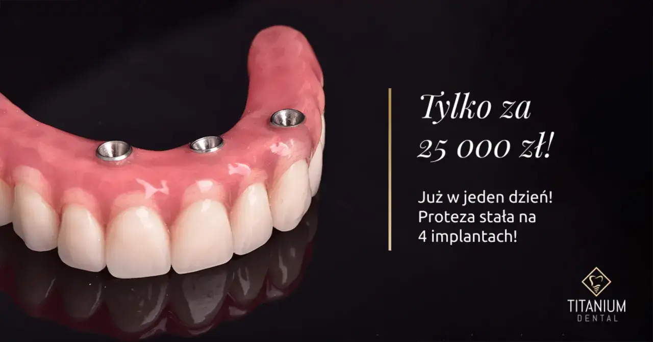 Proteza stała na 4 implantach w jeden dzień! Sprawdź cennik zębów w jeden dzień. Cena 25 000 zł.