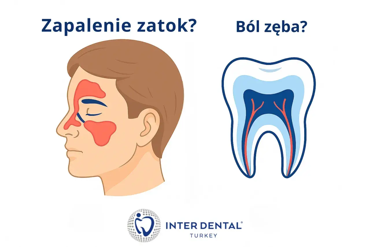 Zapalenie zatok czy ból wszystkich zębów? Ilustracja przedstawia profil mężczyzny z zaznaczonymi zatokami oraz przekrój zęba z widocznymi nerwami.